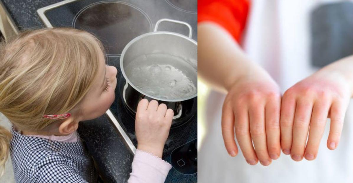 Cách sơ cứu khi bị bỏng nước sôi