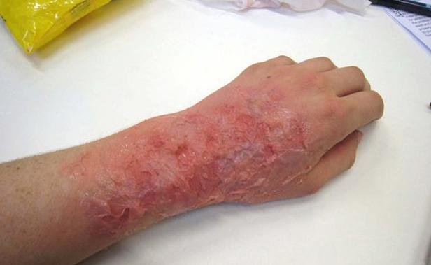  cách sơ cứu bỏng 
